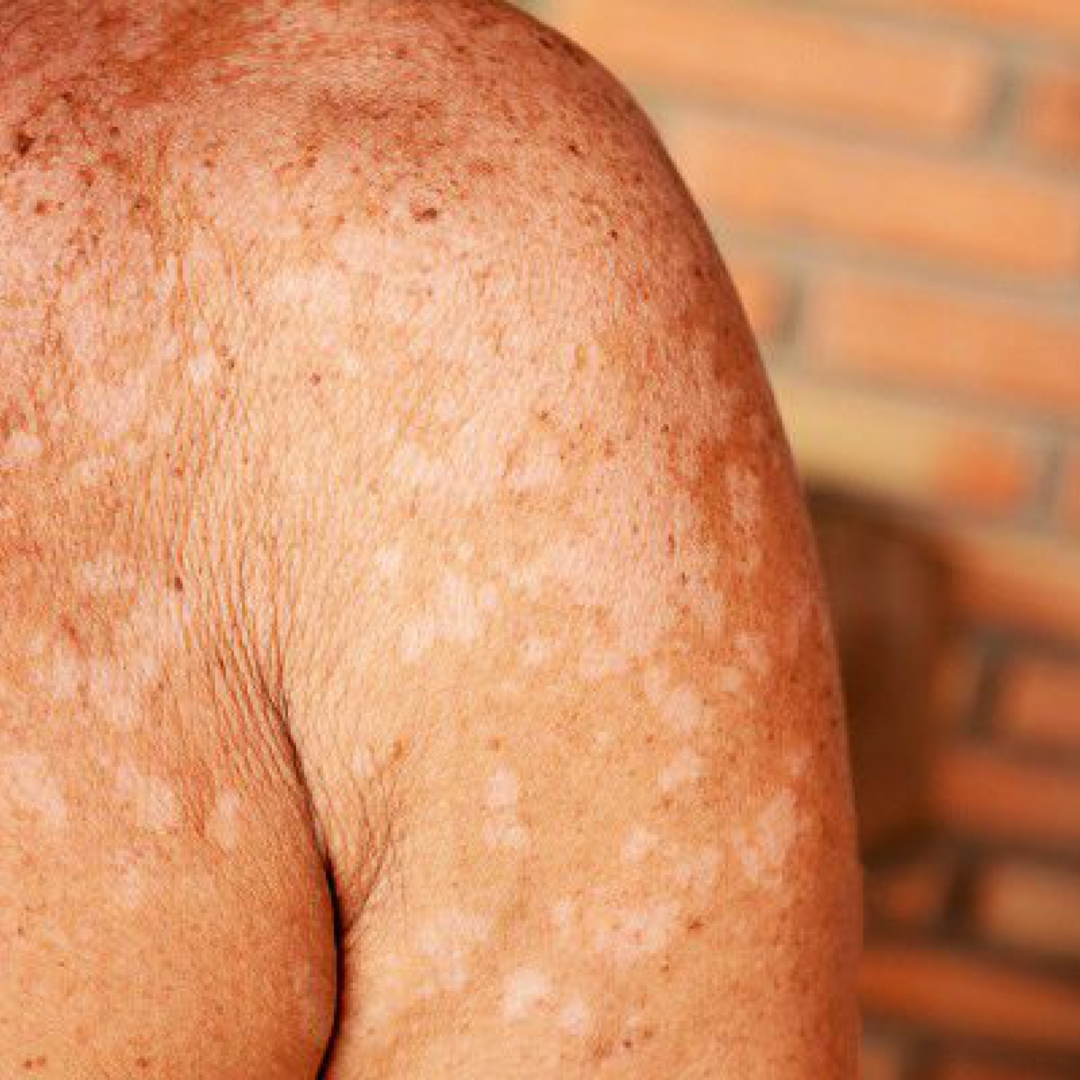 Evita quemaduras y manchas de la piel